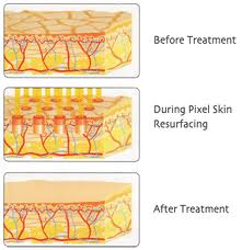 Svetlana Skin Secrets, fractional skin resurfacing